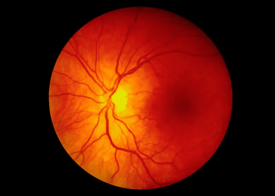 Implante de retina permite que pessoas cegas voltem a ler